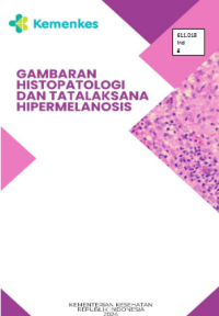 Image of Gambaran Histopatologi dan Tatalaksana Hipermelanosis